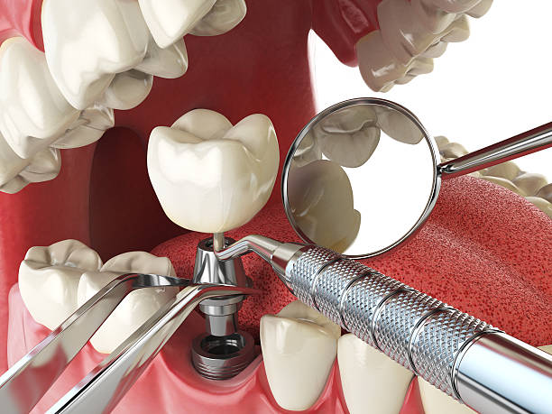 Best Urgent Care for Lost Fillings or Crowns in North Utica, IL